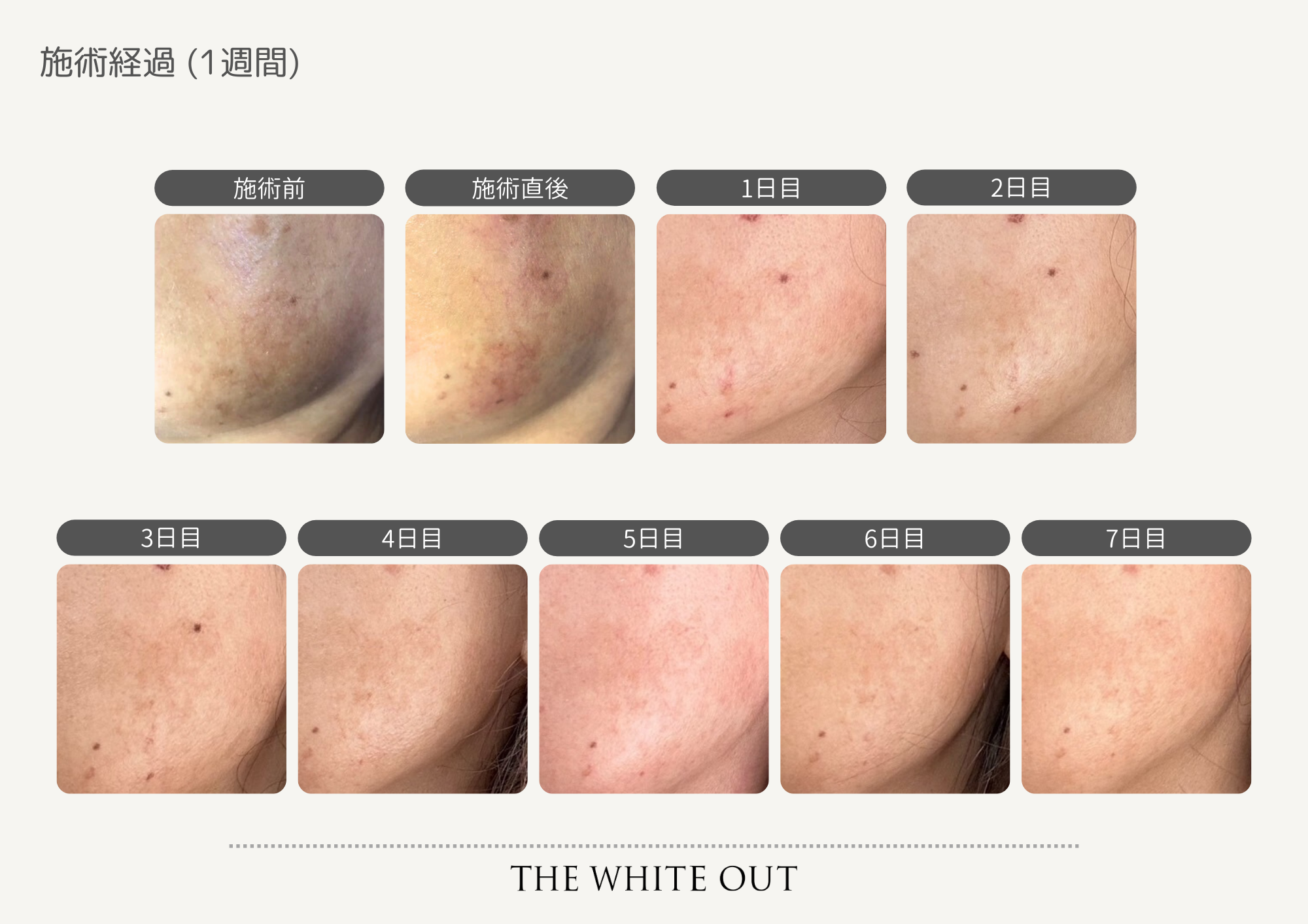 THE WHITE OUT 施術経過②